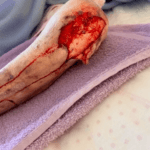 0500165 - Large skin tear - Photo #3