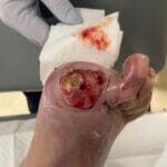 0816099 - Hypergranulation - 18042024 Photo #2