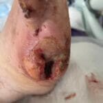 0964814 - Fifthe toe amputation - Photo #2