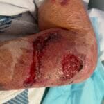 10462145 - Skin tear arm - Photo# 2