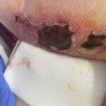 11110795 - PI on leg and sacrum - Photo #3