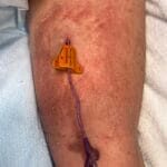 1175647 - PICC skin stripping - Photo #1