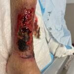 1191838 - Vascularitis - 20240311 - Ph#6