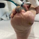 1202181 - Necrotic toe - Photo #1