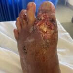 12237109 - Rheumatoid wound - Photo #1