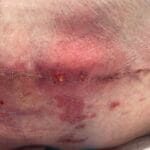 12296584 - Spinal fusion - Photo #2