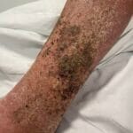 1425799 - Hyperkeratosis - 09042024 - Photo #4