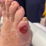 20052024 - Diabetic ulcer - photo #6