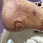20052024 - Diabetic ulcer - photo #9