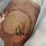 4509060 - Flap and donor site - Photo #4