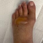 8073530 - Blister from TEDs - 02052024 - Ph#1