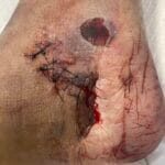 9065789 -Crush injury Photo #2