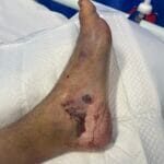 9065789 -Crush injury Photo #3