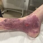 Arterial Stenosis - 1063636 - Photo 7