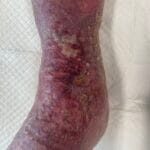 Epidermis Breakdown - 962676 -Picture 4