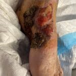 Hypergrannulation - 0956100 - Photo 1- Feature - 20240122