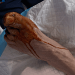 Ischaemic Toes -Multiple toes and heel injury - Picture #3
