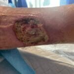 Mixed ulcer - 0764806 - photo#1