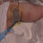 Vac - Large leg wound - nicely done #10