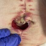 dehisced abdo wound -1481133 - Photo 2