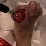 hypergranulation-toe